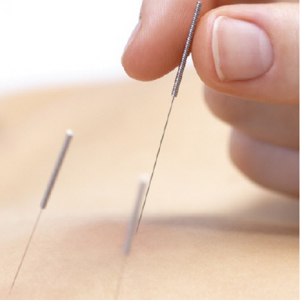 Acupuntura y Moxibustion